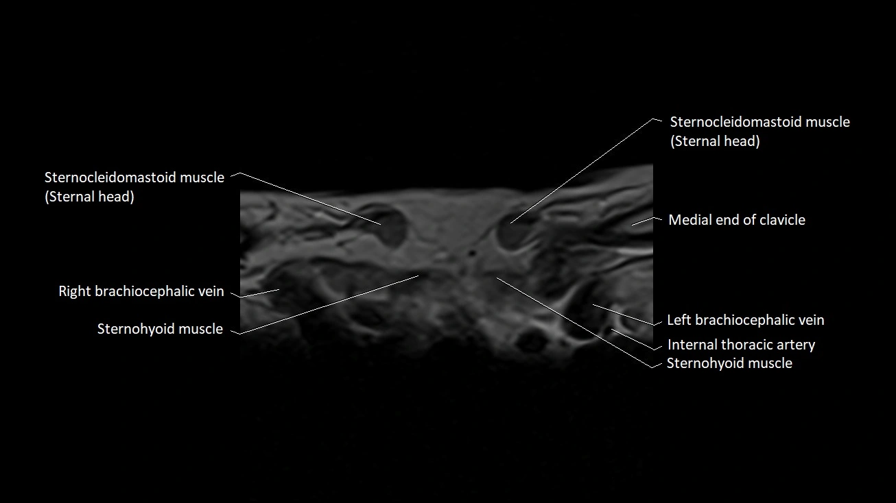 MRI sternum and sternoclavicular joint labeled axial anatomy image 1.webp